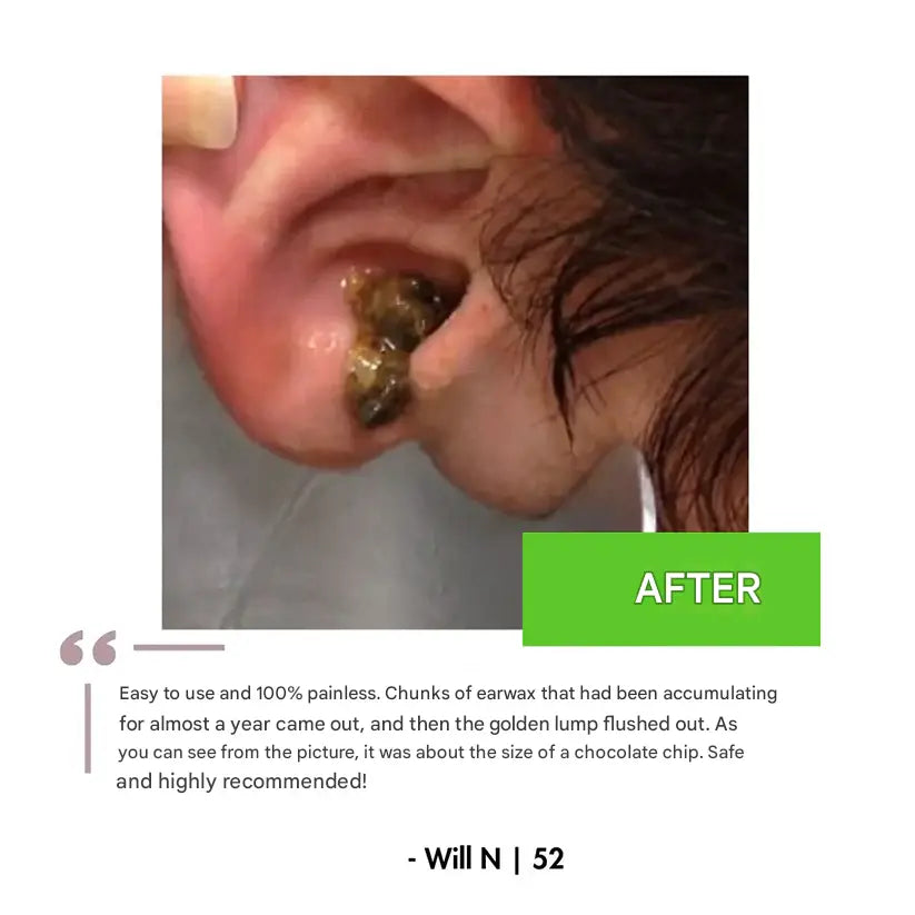 Drexa™ PRO Ear Cleaner 2.0 Drexa